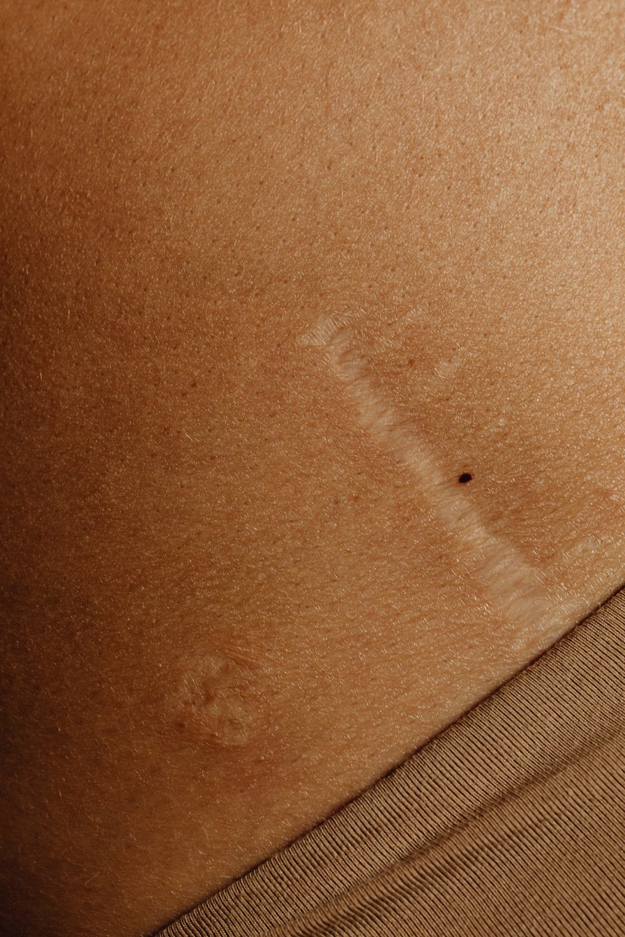 Close-up of Woman Body with Scar